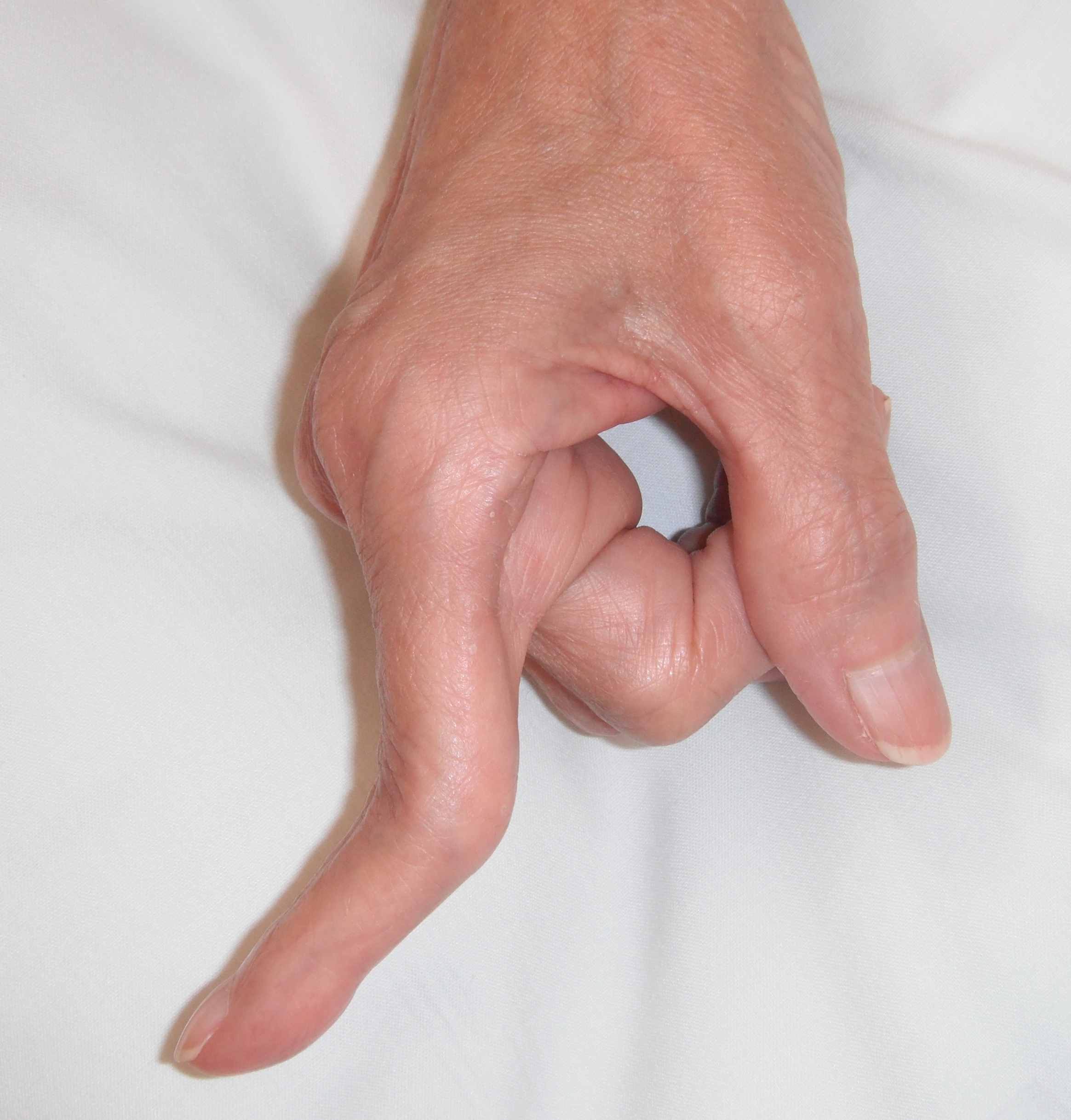 Rheumatoid Boutonniere Finger